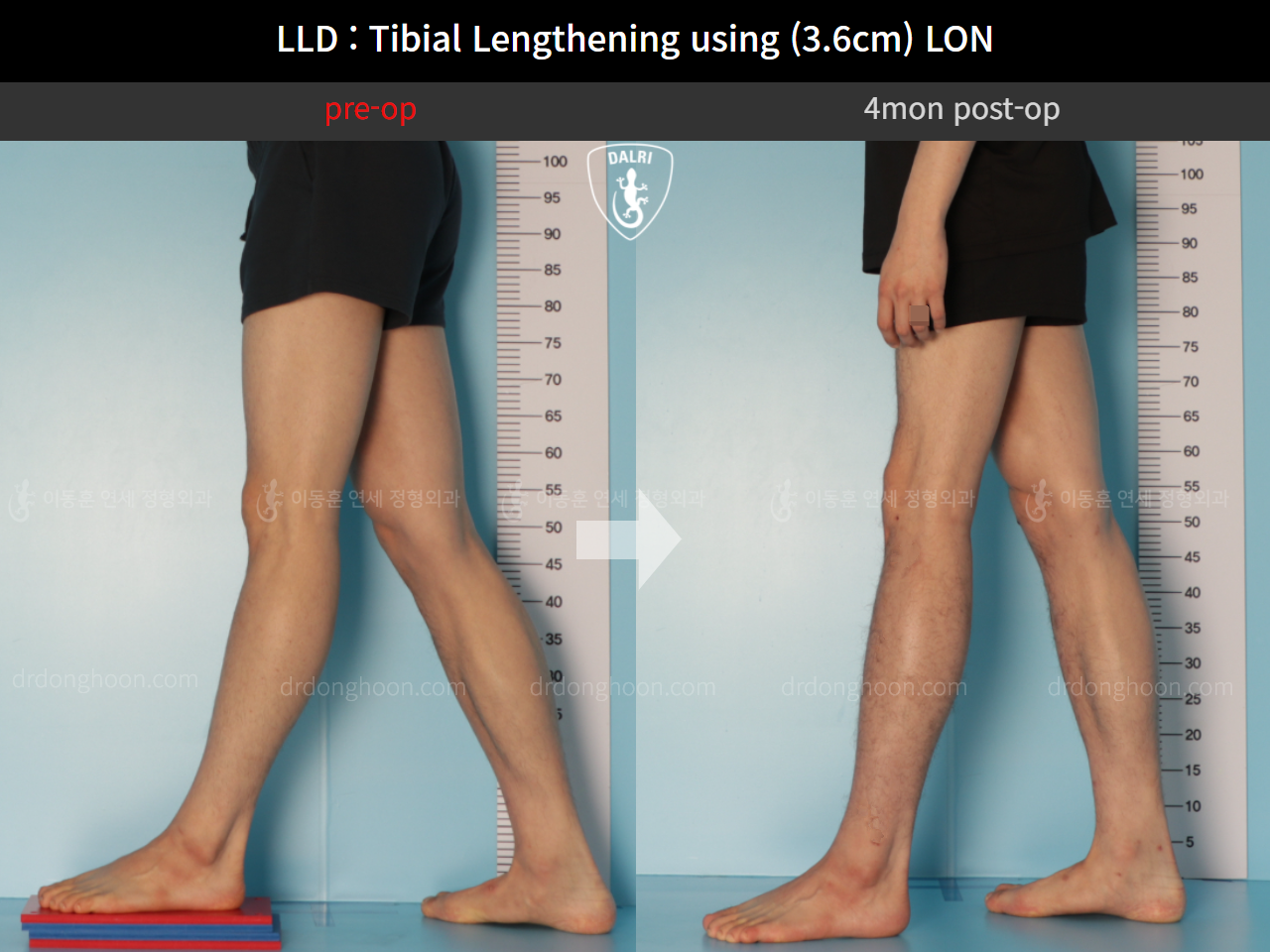 Before and after adult lld, case 11093753, image 6, Dr. Donghoon institute (DALRI)