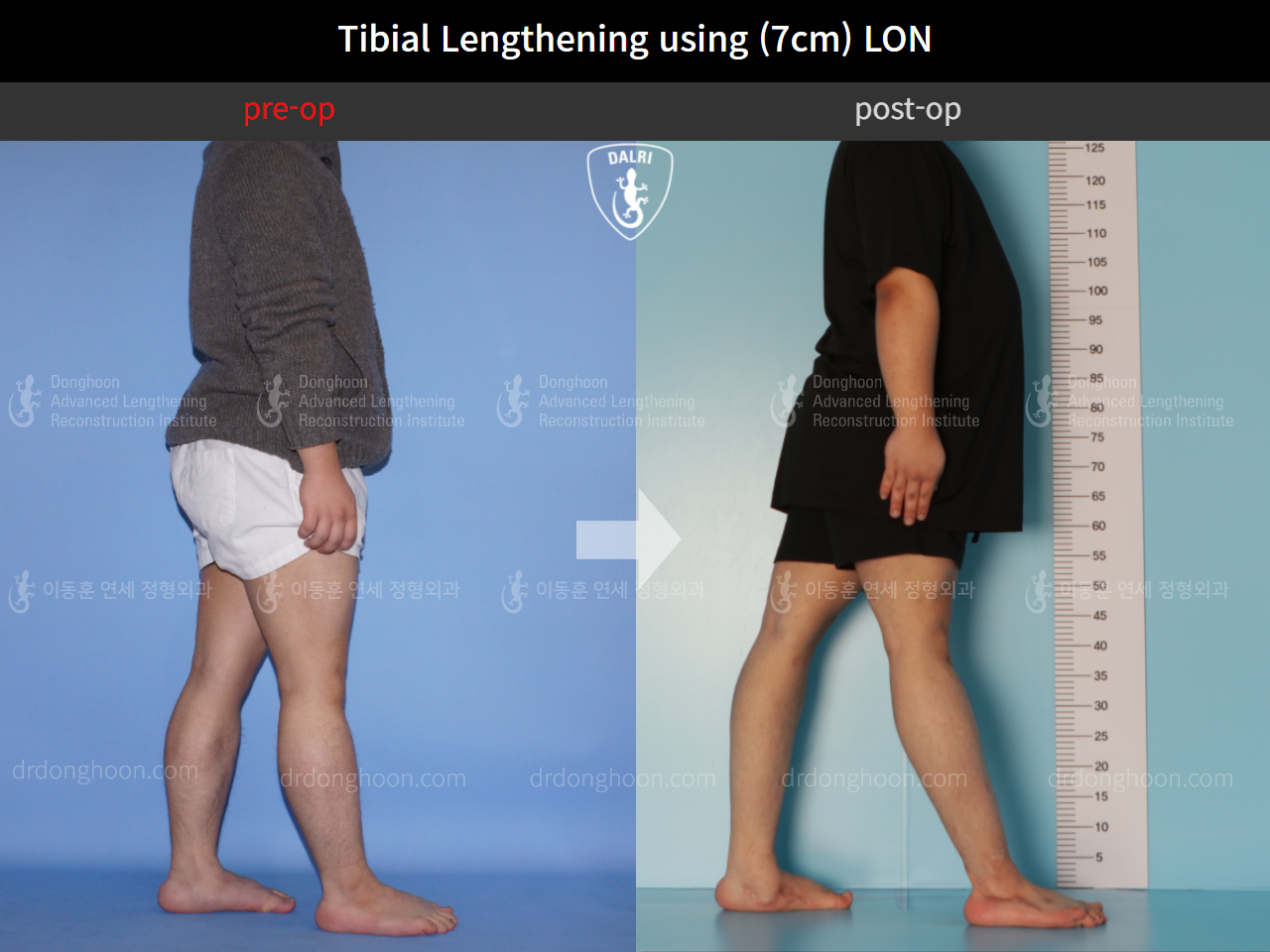 Before and after cll lon, case 10452499, image 3, Dr. Donghoon institute (DALRI)