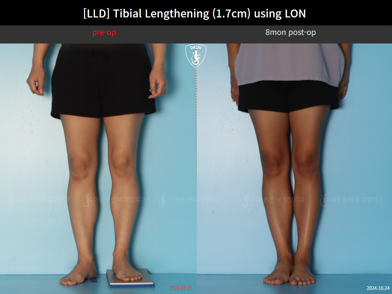 Before and after adult lld, case 126715948, image 5, Dr. Donghoon institute (DALRI)