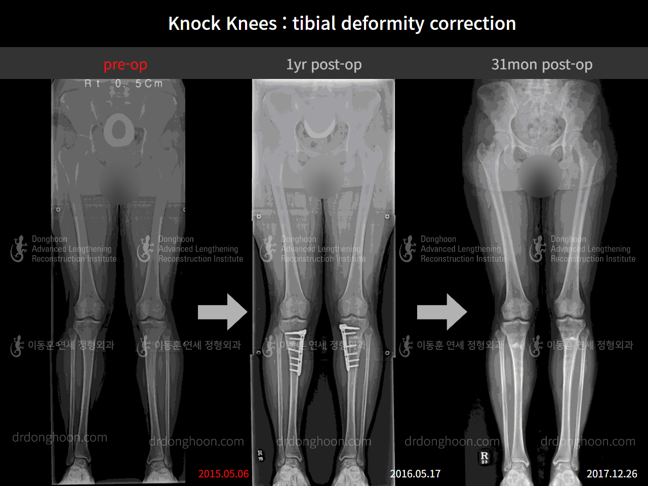Before and after adult knock knees, case 4586314, image 5, Dr. Donghoon institute (DALRI)