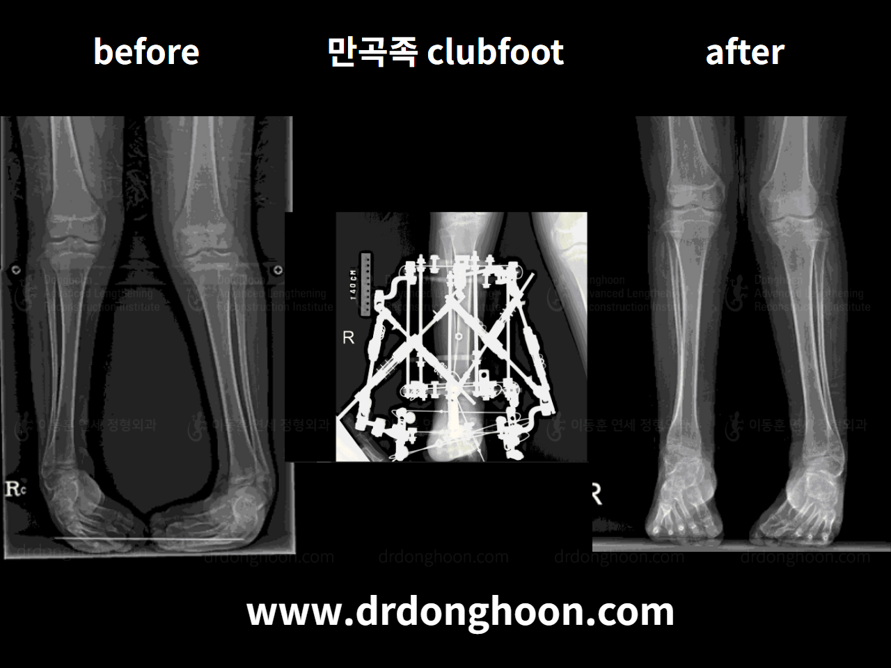 Before and after paediatric congenital condition, case 4304688, image 3, Dr. Donghoon institute (DALRI)