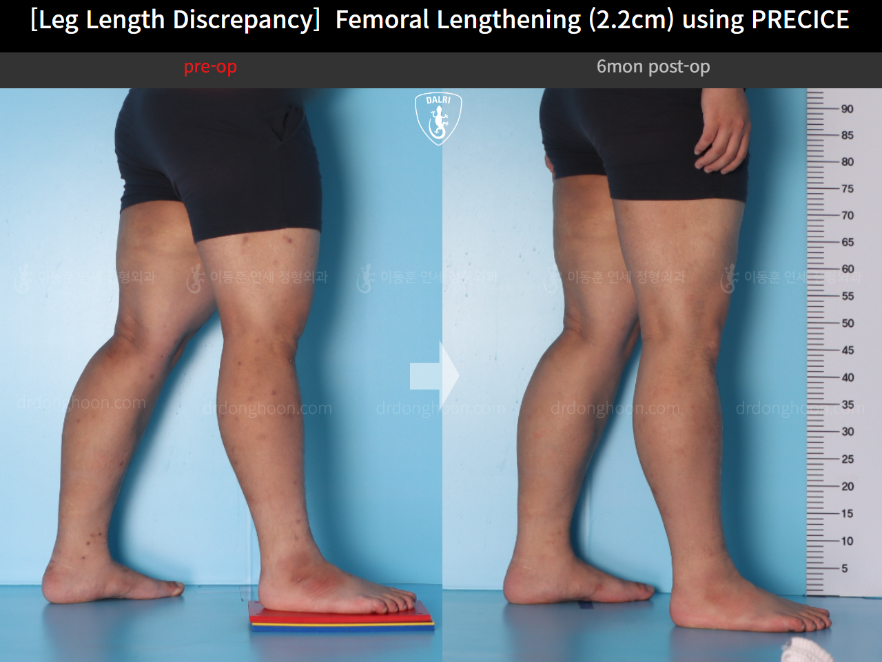 Before and after adult lld, case 15416698, image 7, Dr. Donghoon institute (DALRI)