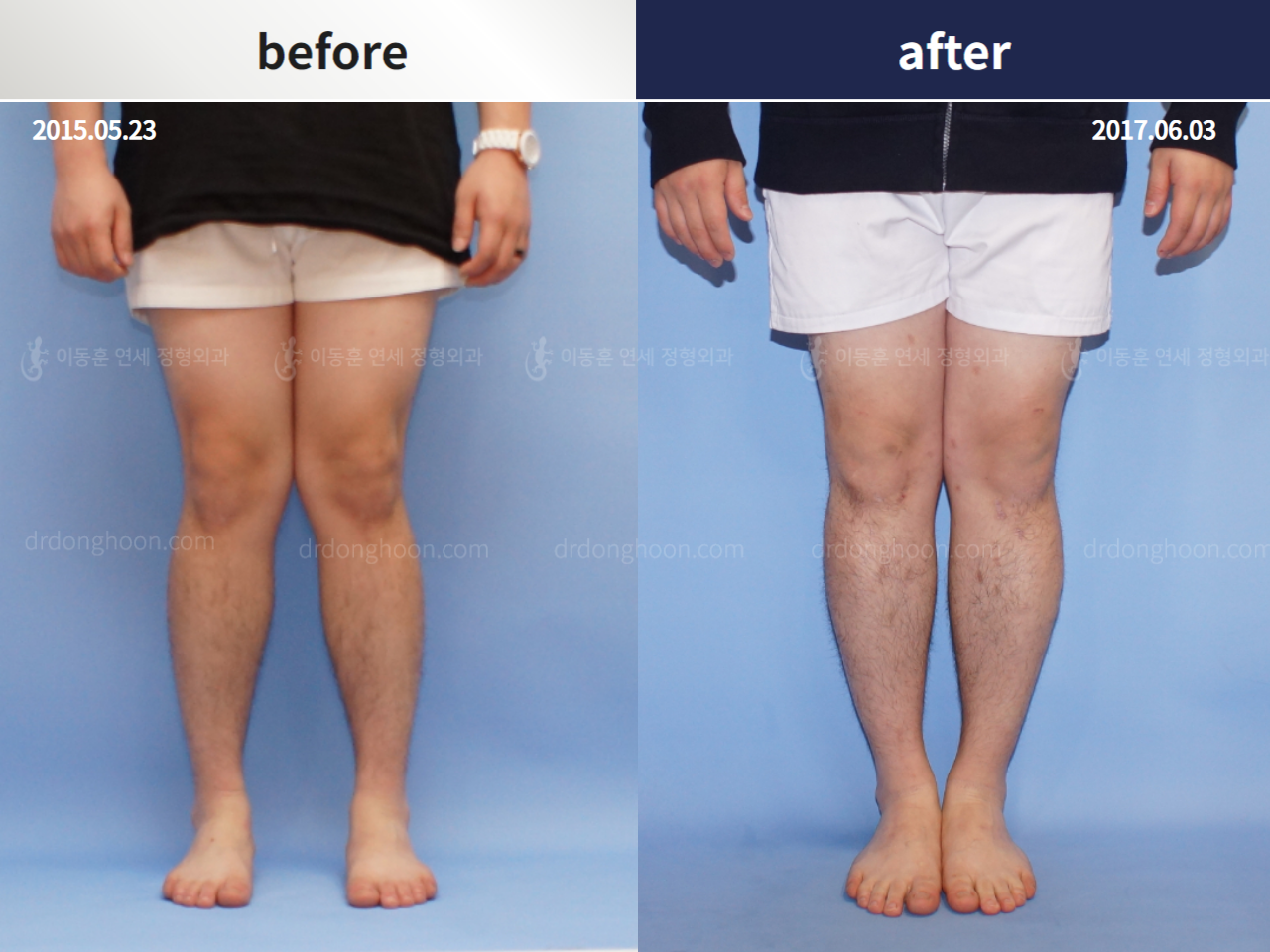 Before and after reoperation after deformity correction, case 4306345, image 1, Dr. Donghoon institute (DALRI)