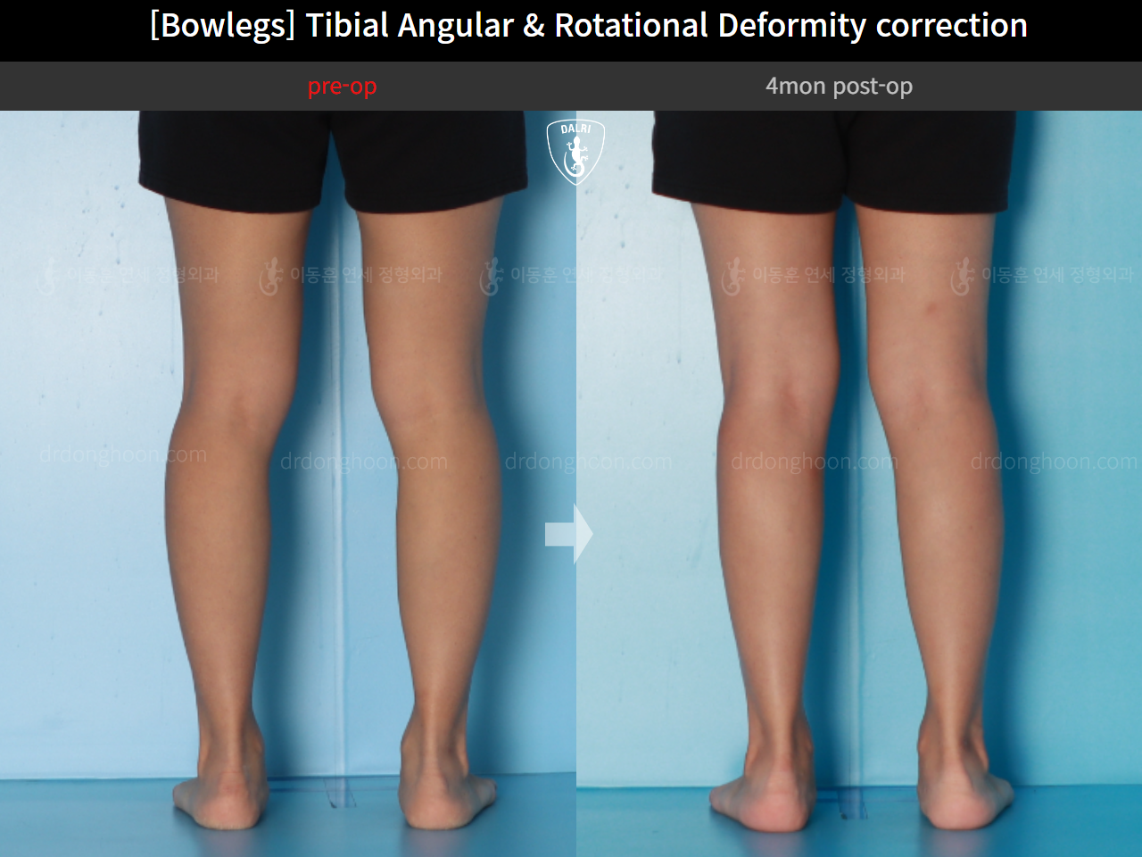 Before and after adult bowlegs, case 16530390, image 10, Dr. Donghoon institute (DALRI)