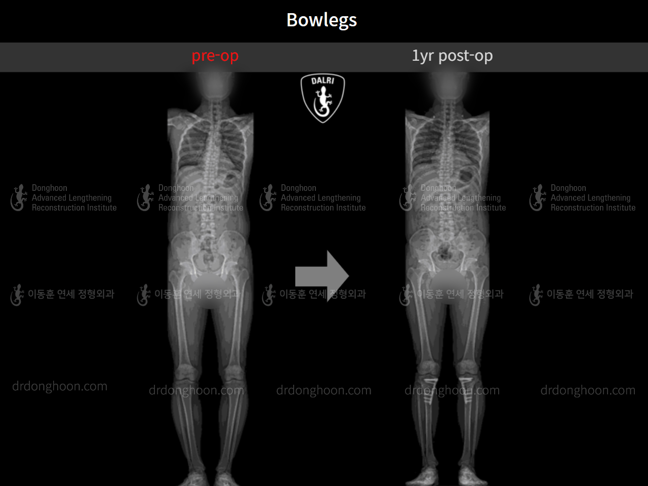 Before and after adult bowlegs, case 9487634, image 5, Dr. Donghoon institute (DALRI)