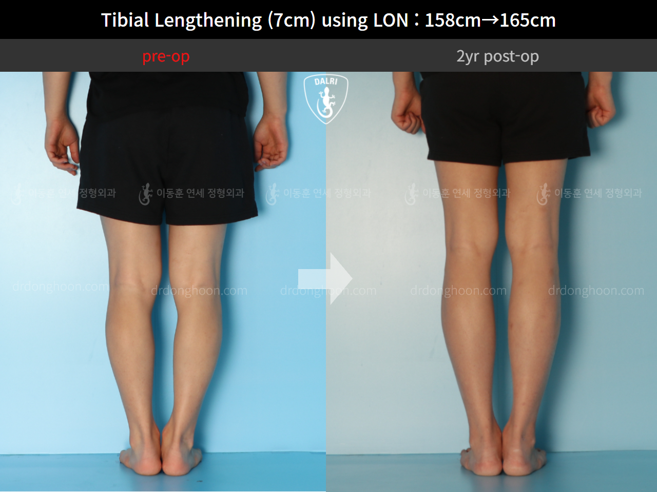 Before and after cll lon, case 9325768, image 6, Dr. Donghoon institute (DALRI)