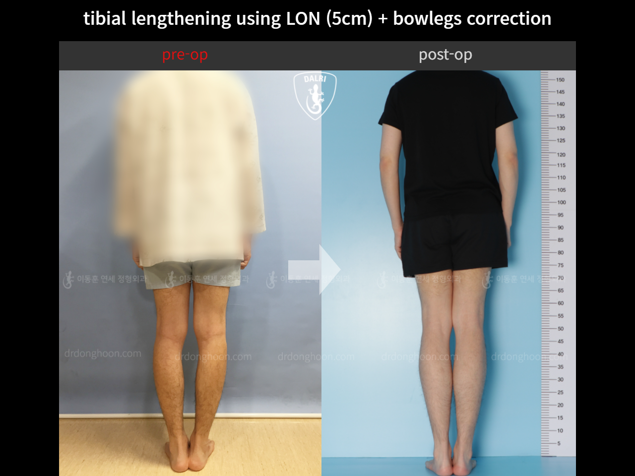 Before and after cll + deformity correction, case 4323130, image 2, Dr. Donghoon institute (DALRI)
