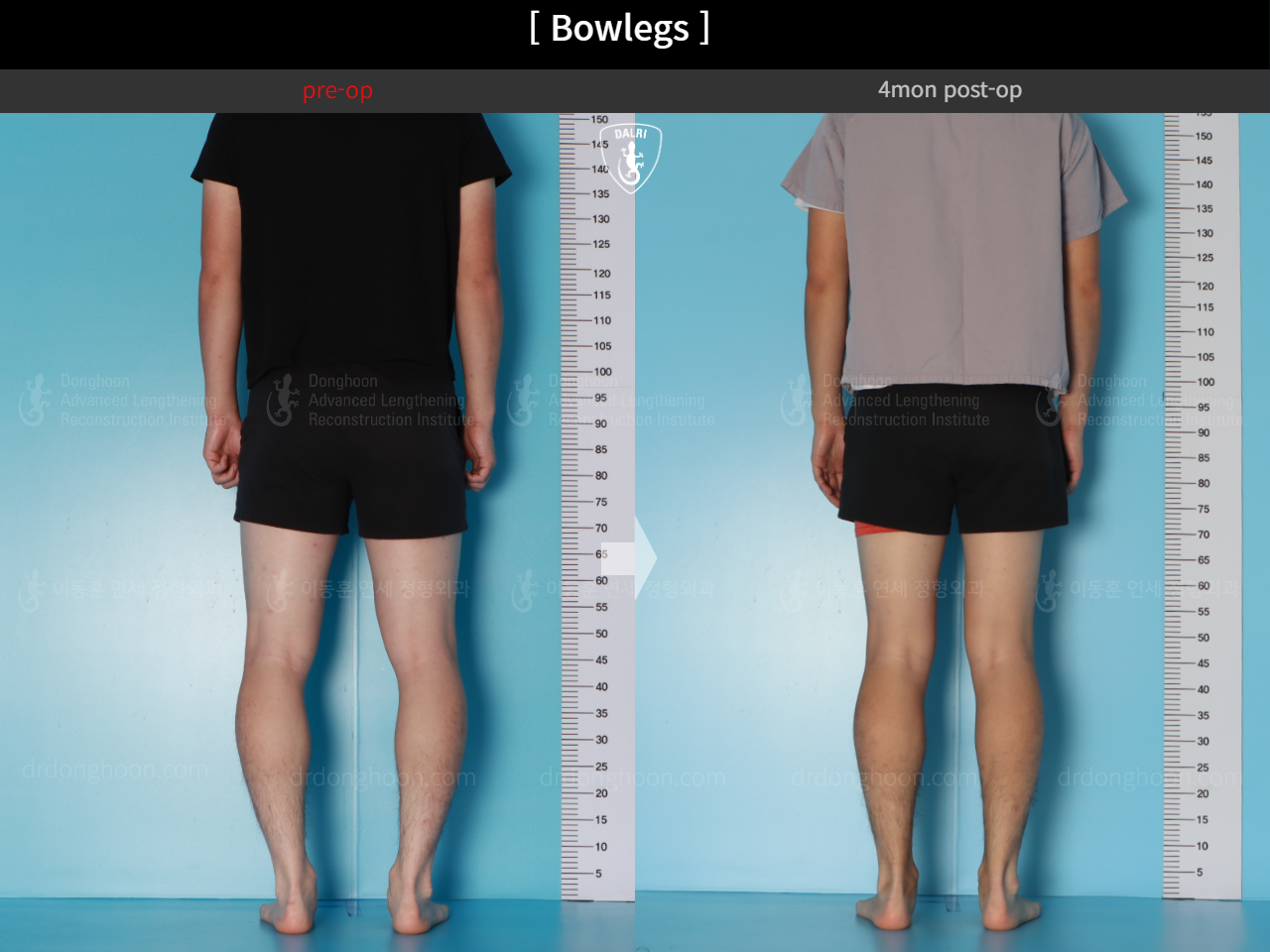 Before and after adult bowlegs, case 18479637, image 5, Dr. Donghoon institute (DALRI)