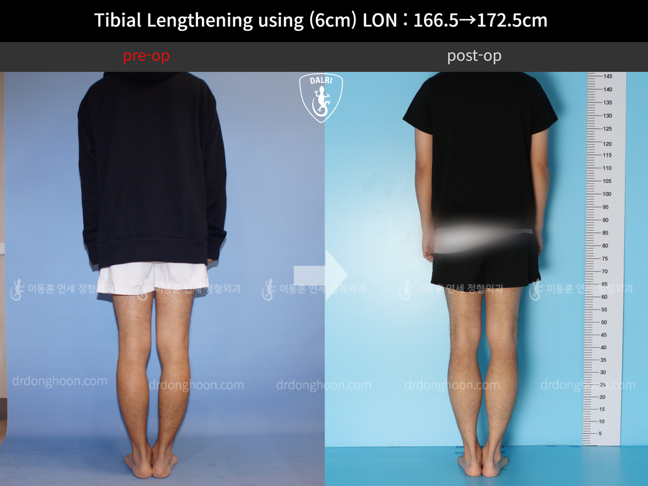 Before and after cll lon, case 11980239, image 2, Dr. Donghoon institute (DALRI)