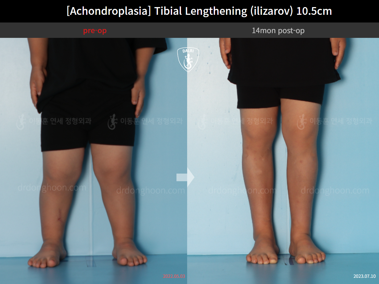 Before and after paediatric congenital condition, case 15707315, image 4, Dr. Donghoon institute (DALRI)