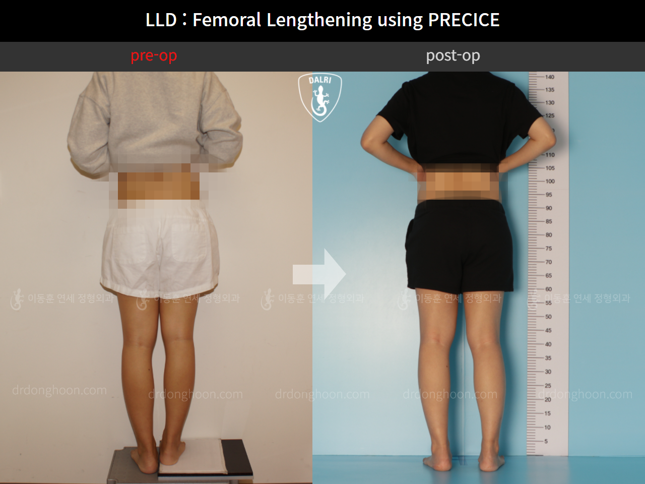 Before and after adult lld, case 10713336, image 2, Dr. Donghoon institute (DALRI)