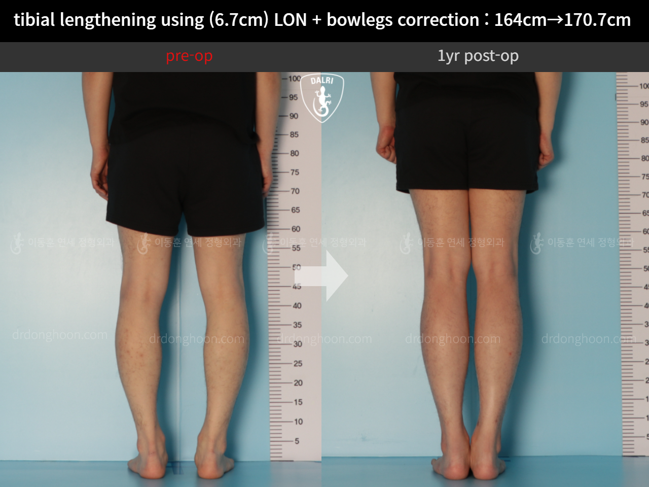 Before and after cll + deformity correction, case 11037343, image 6, Dr. Donghoon institute (DALRI)