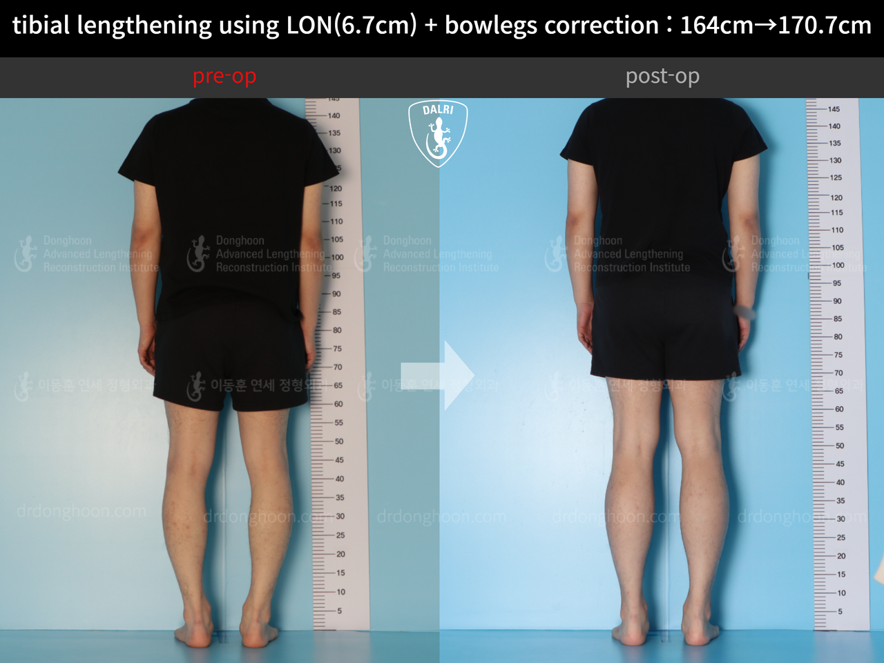 Before and after cll + deformity correction, case 13914972, image 4, Dr. Donghoon institute (DALRI)