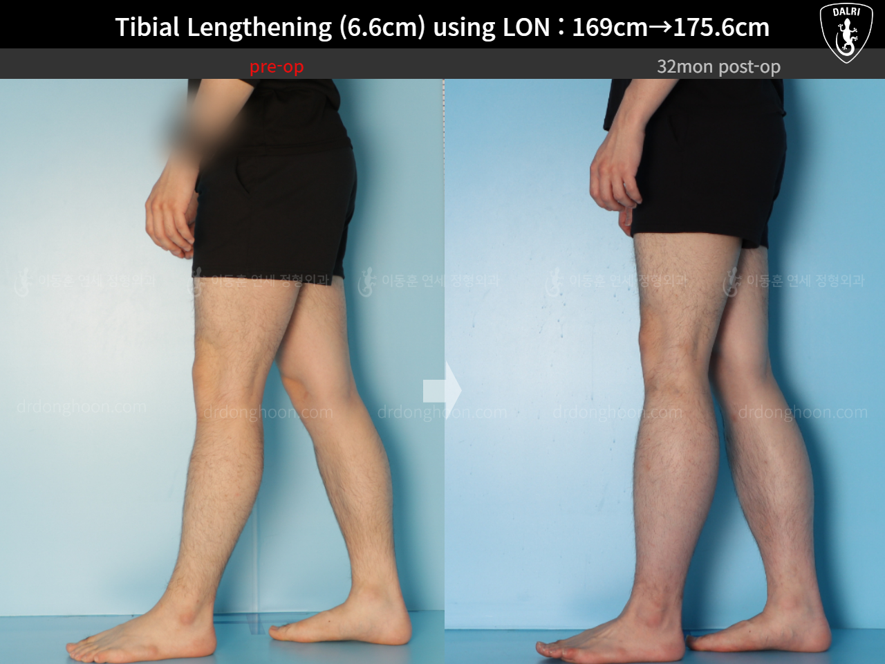Before and after cll lon, case 15166302, image 11, Dr. Donghoon institute (DALRI)