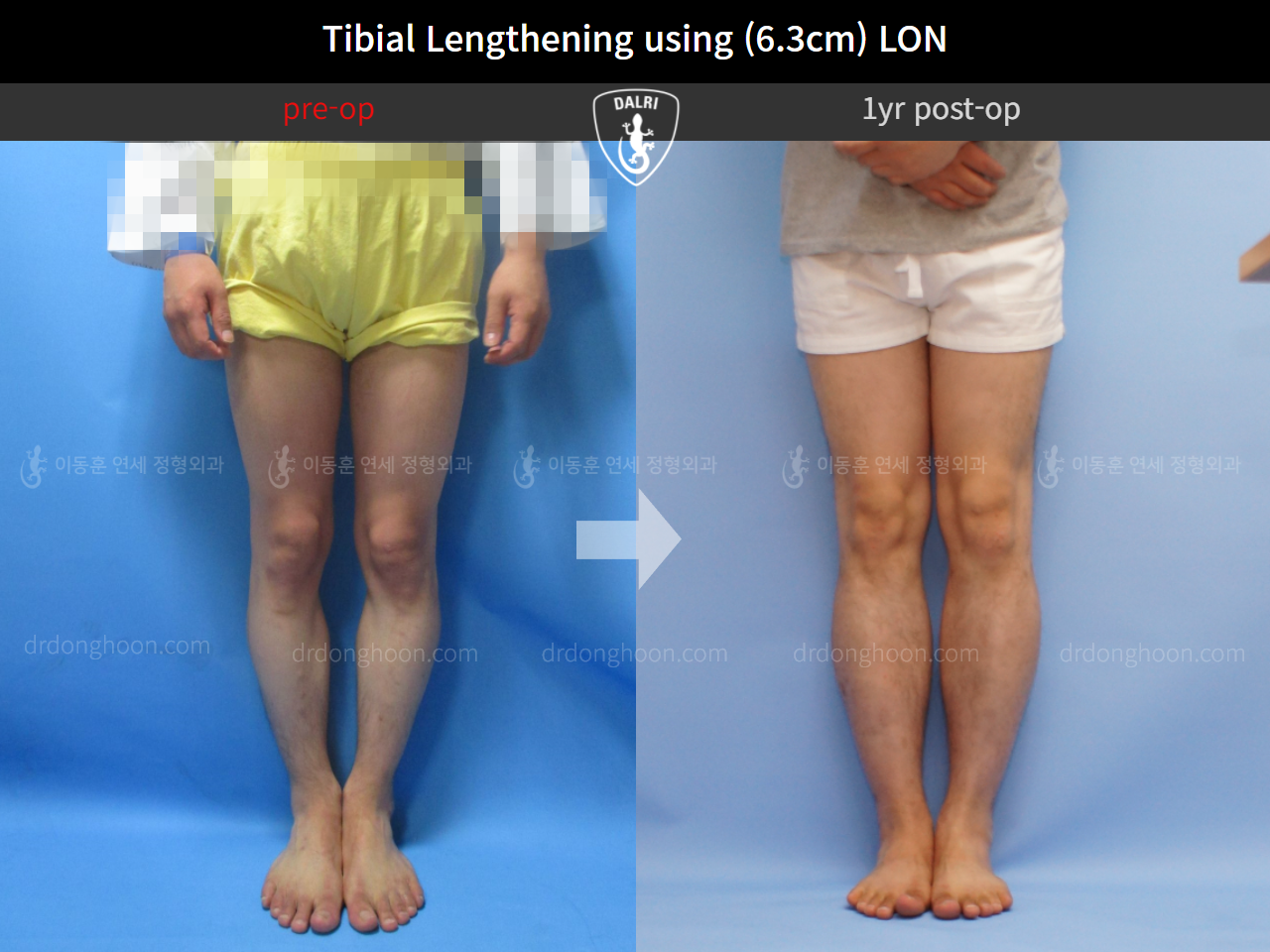 Before and after cll lon, case 4577838, image 5, Dr. Donghoon institute (DALRI)