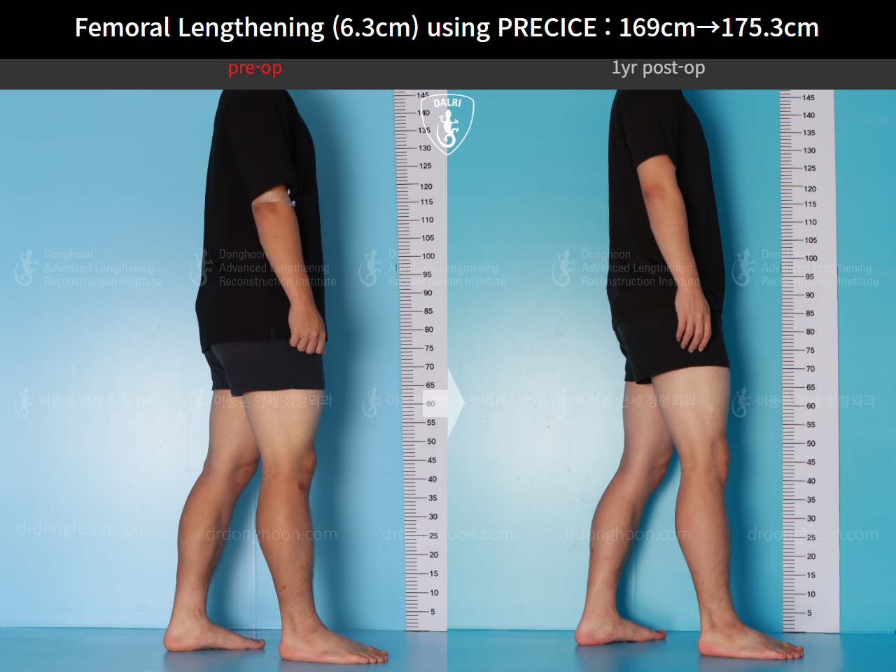 Before and after cll precice, case 16070058, image 5, Dr. Donghoon institute (DALRI)