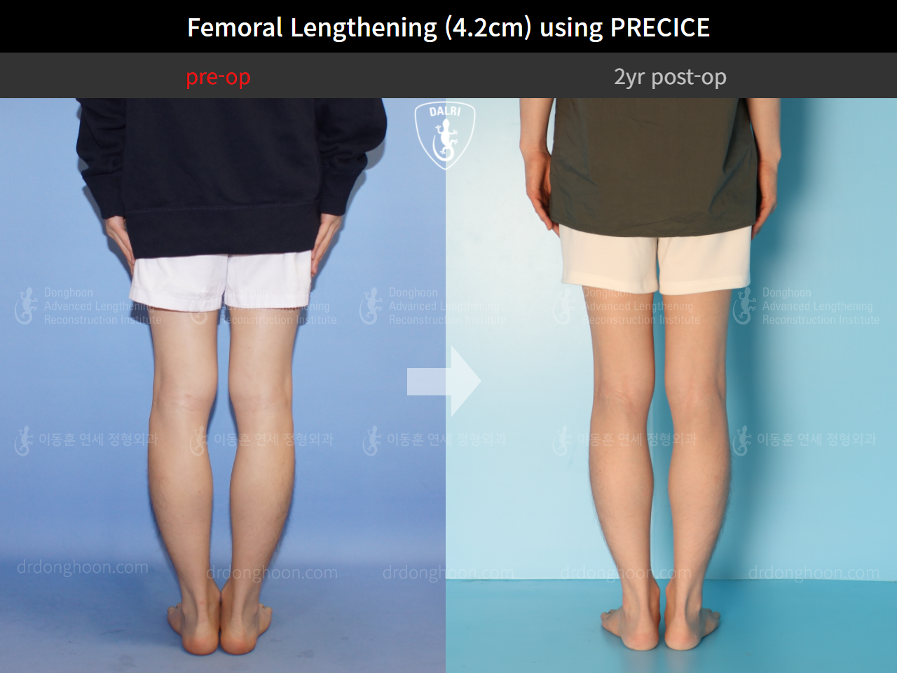 Before and after cll precice, case 4323396, image 6, Dr. Donghoon institute (DALRI)