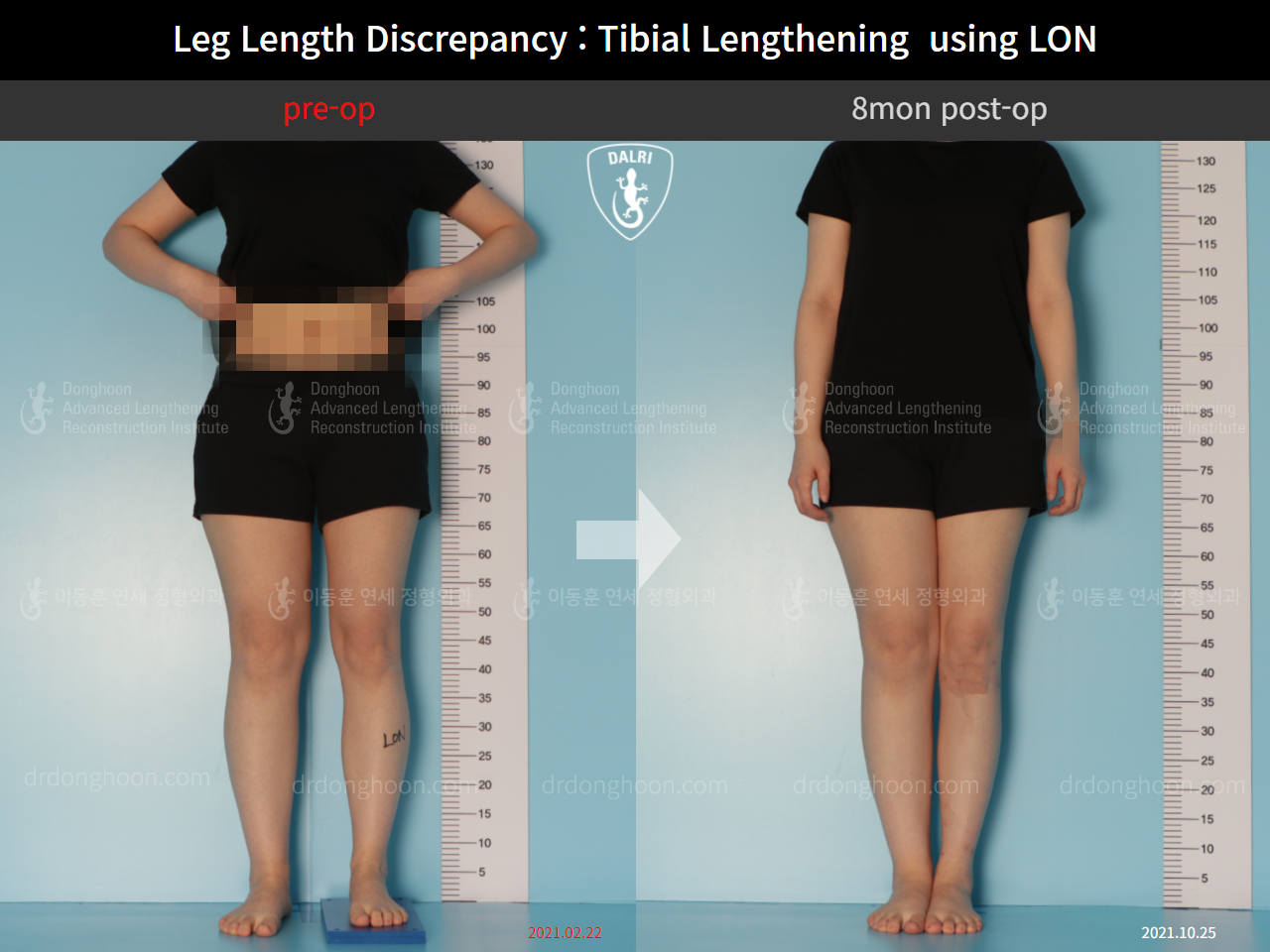 Before and after adult lld, case 10477860, image 1, Dr. Donghoon institute (DALRI)