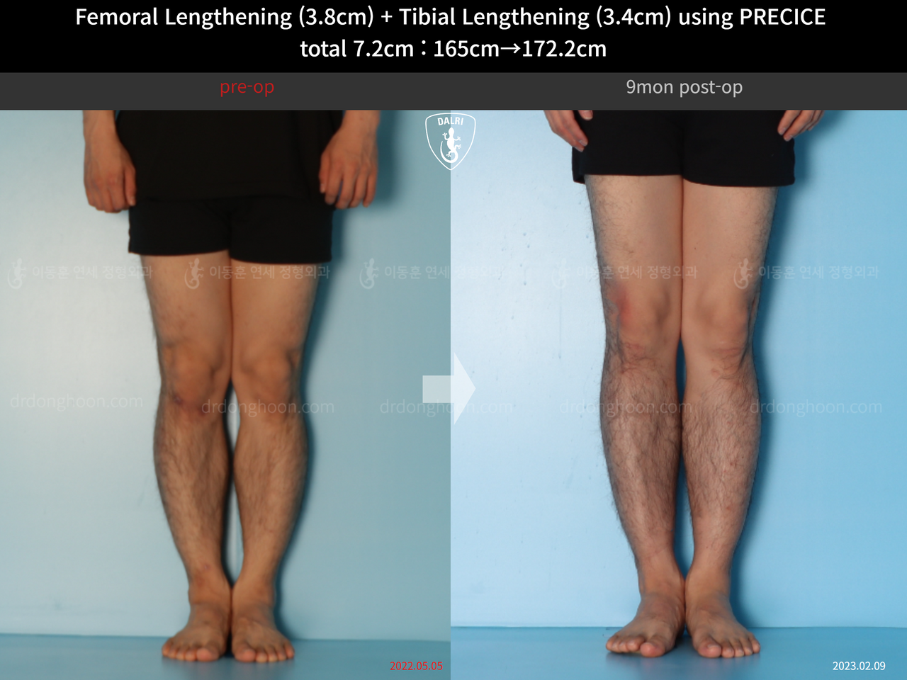 Before and after cll precice, case 14220657, image 7, Dr. Donghoon institute (DALRI)
