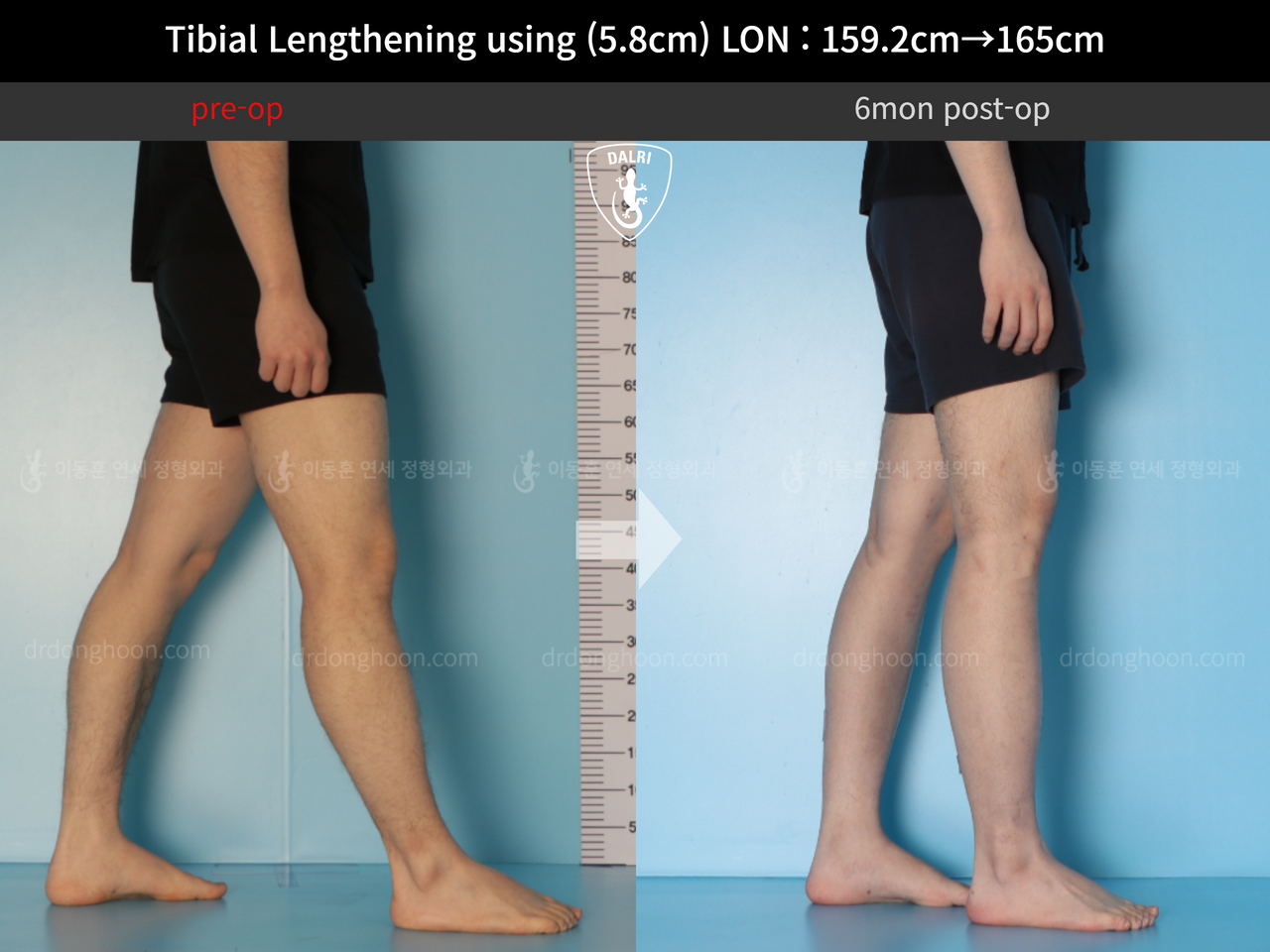 Before and after cll lon, case 12791053, image 8, Dr. Donghoon institute (DALRI)