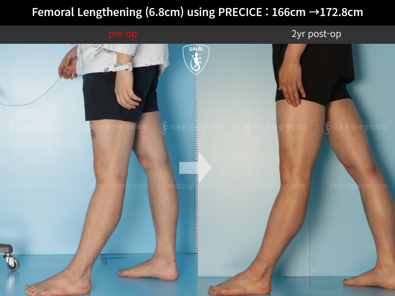 Before and after cll precice, case 10883099, image 7, Dr. Donghoon institute (DALRI)