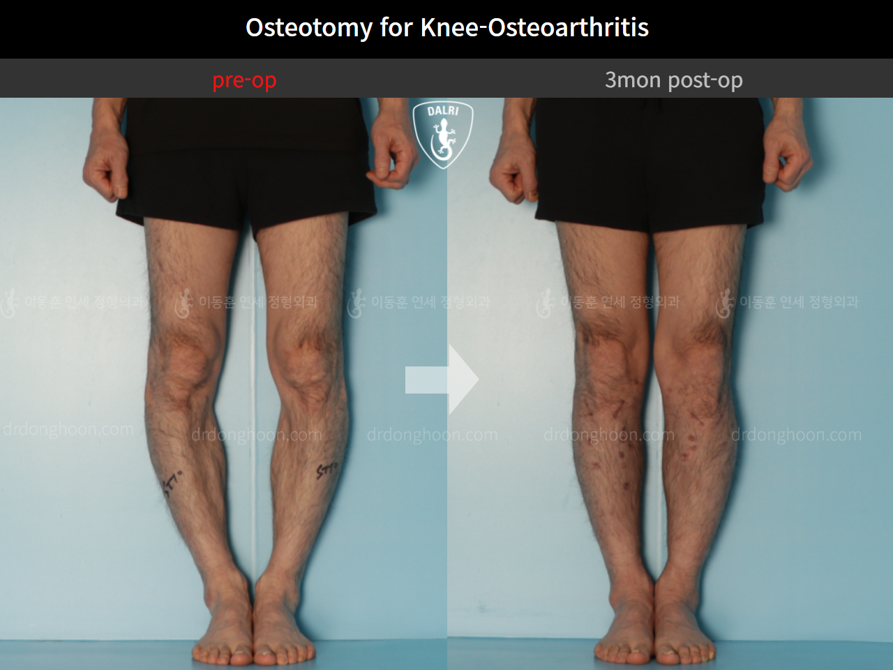 Before and after osteotomy for knee osteoarthritis, case 10445104, image 3, Dr. Donghoon institute (DALRI)