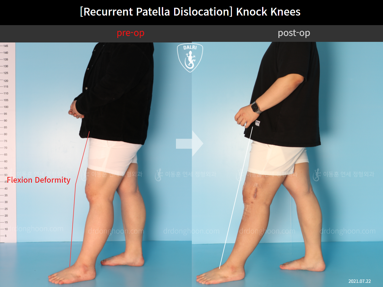 Before and after adult knock knees, case 10710317, image 5, Dr. Donghoon institute (DALRI)