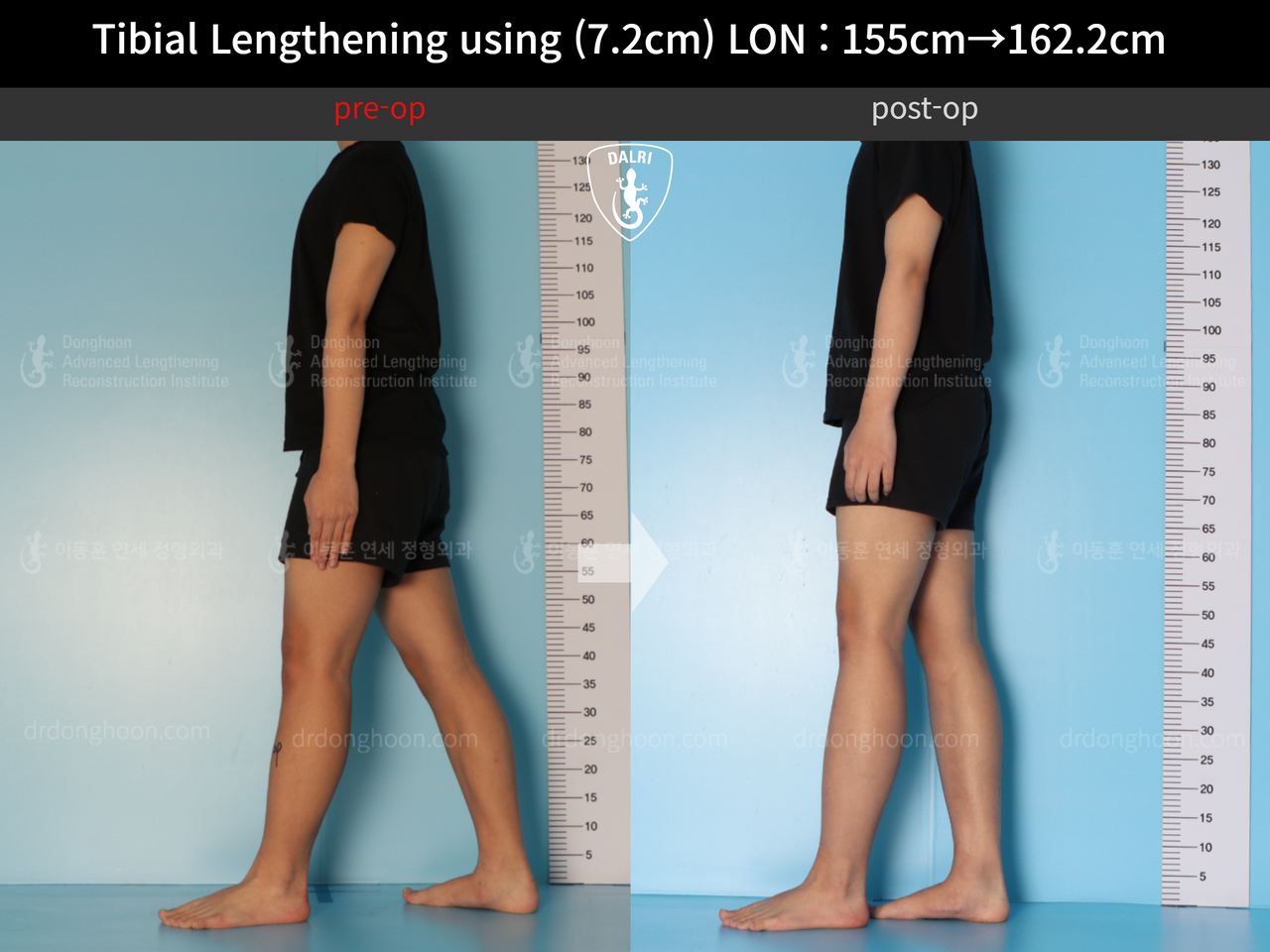 Before and after cll lon, case 13635674, image 3, Dr. Donghoon institute (DALRI)