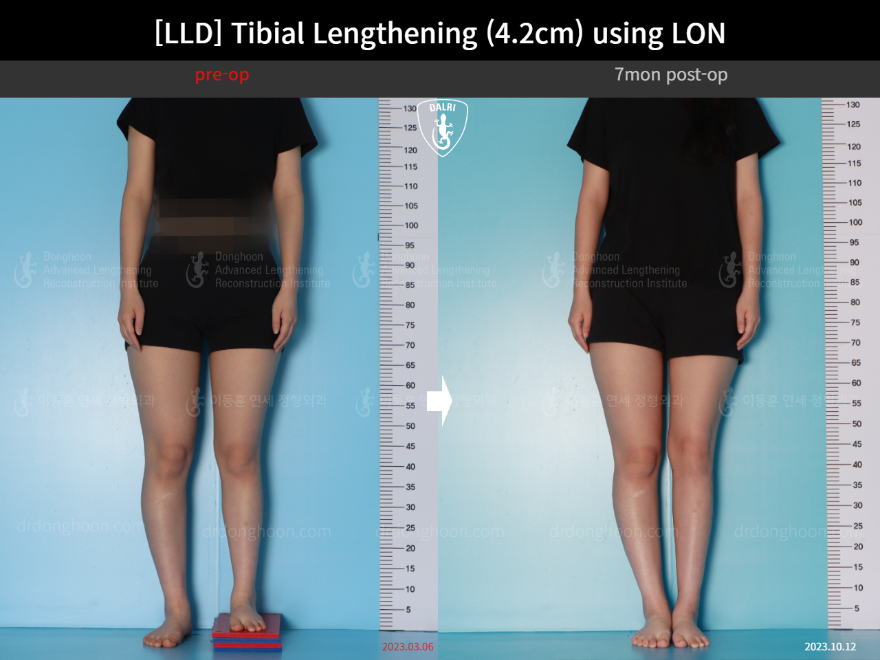 Before and after adult lld, case 16933852, image 3, Dr. Donghoon institute (DALRI)