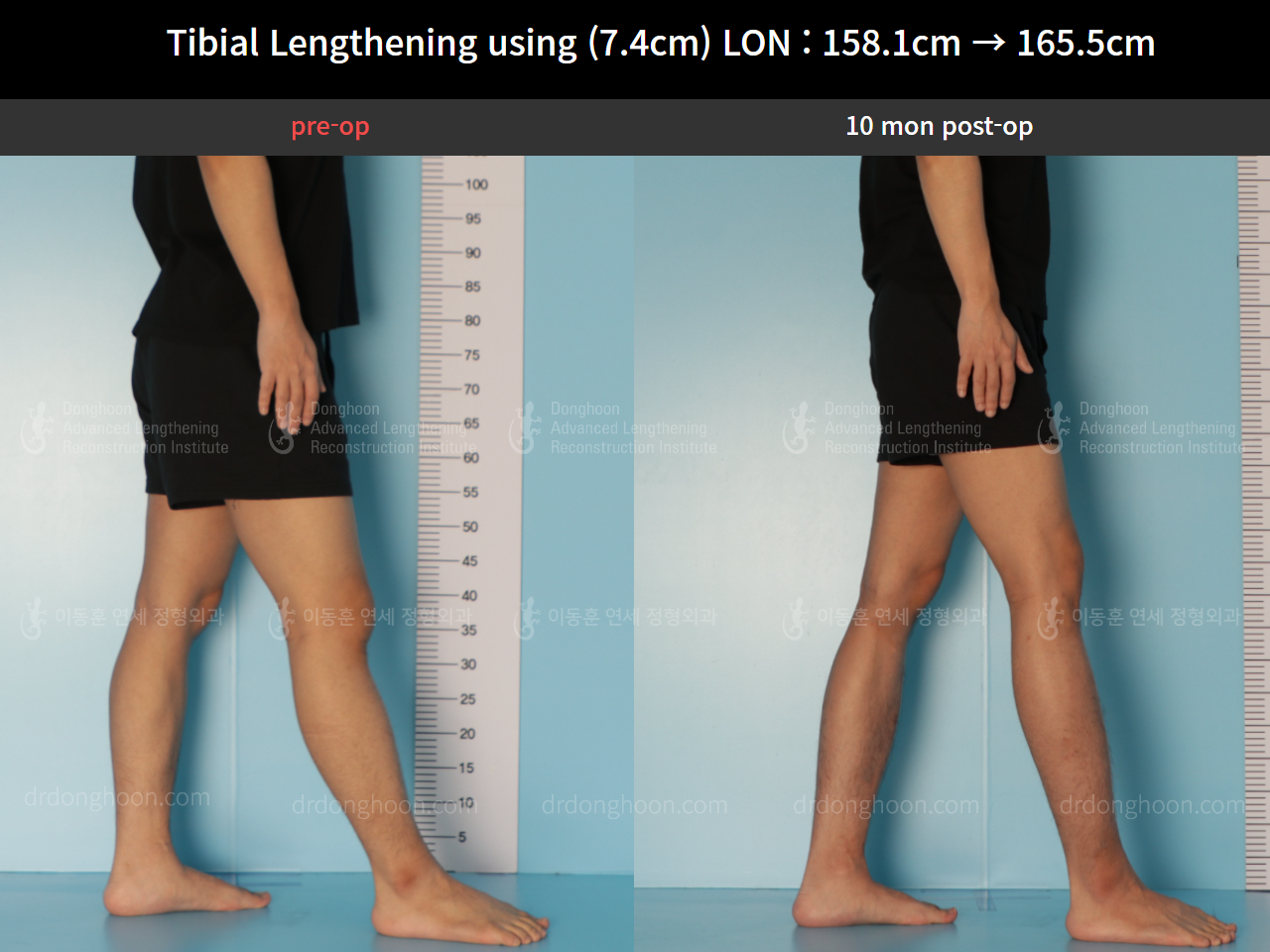 Before and after cll lon, case 8559634, image 7, Dr. Donghoon institute (DALRI)