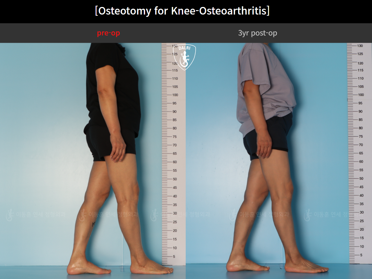 Before and after osteotomy for knee osteoarthritis, case 85842641, image 5, Dr. Donghoon institute (DALRI)