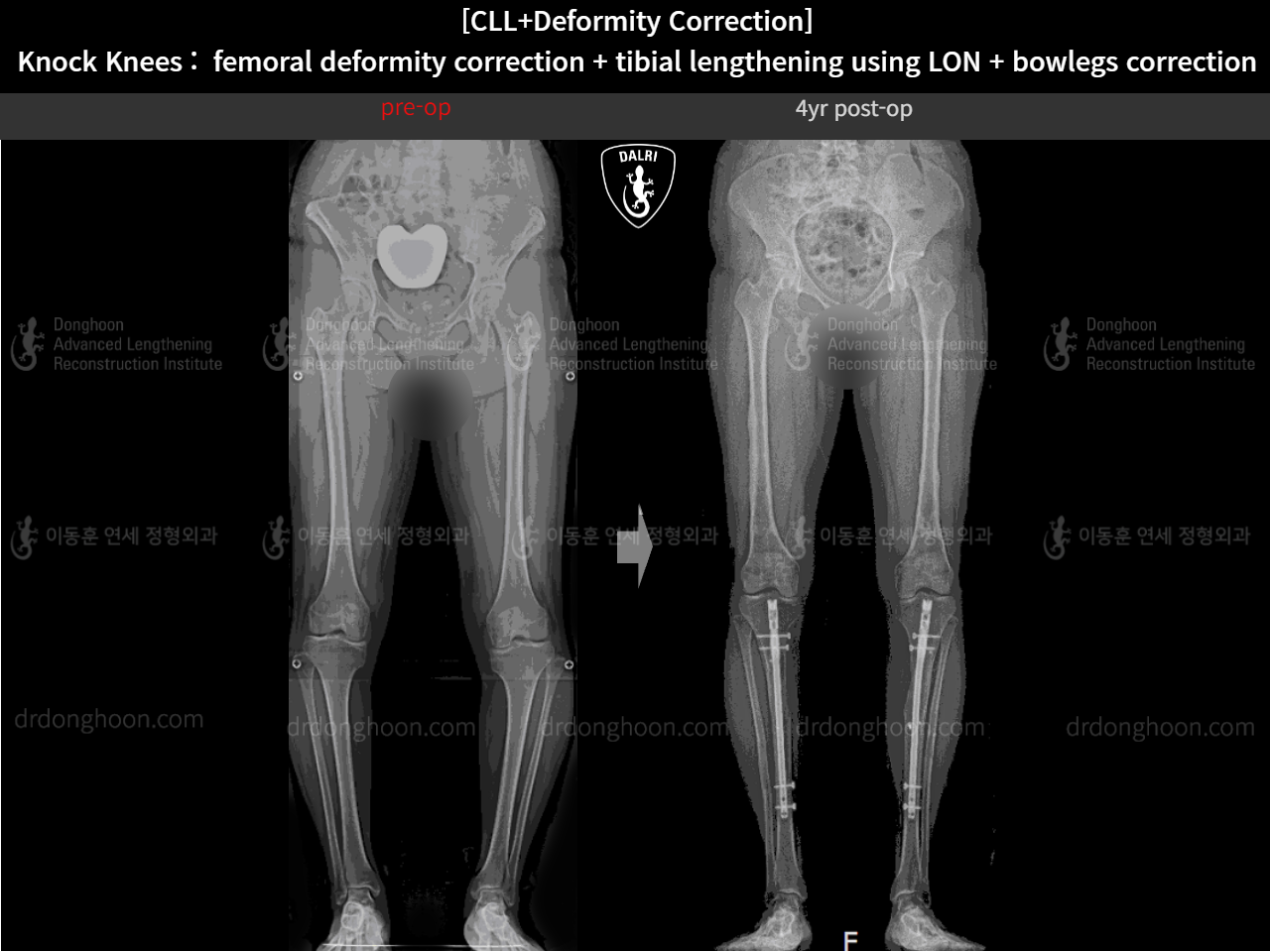 Before and after cll + deformity correction, case 16102788, image 2, Dr. Donghoon institute (DALRI)