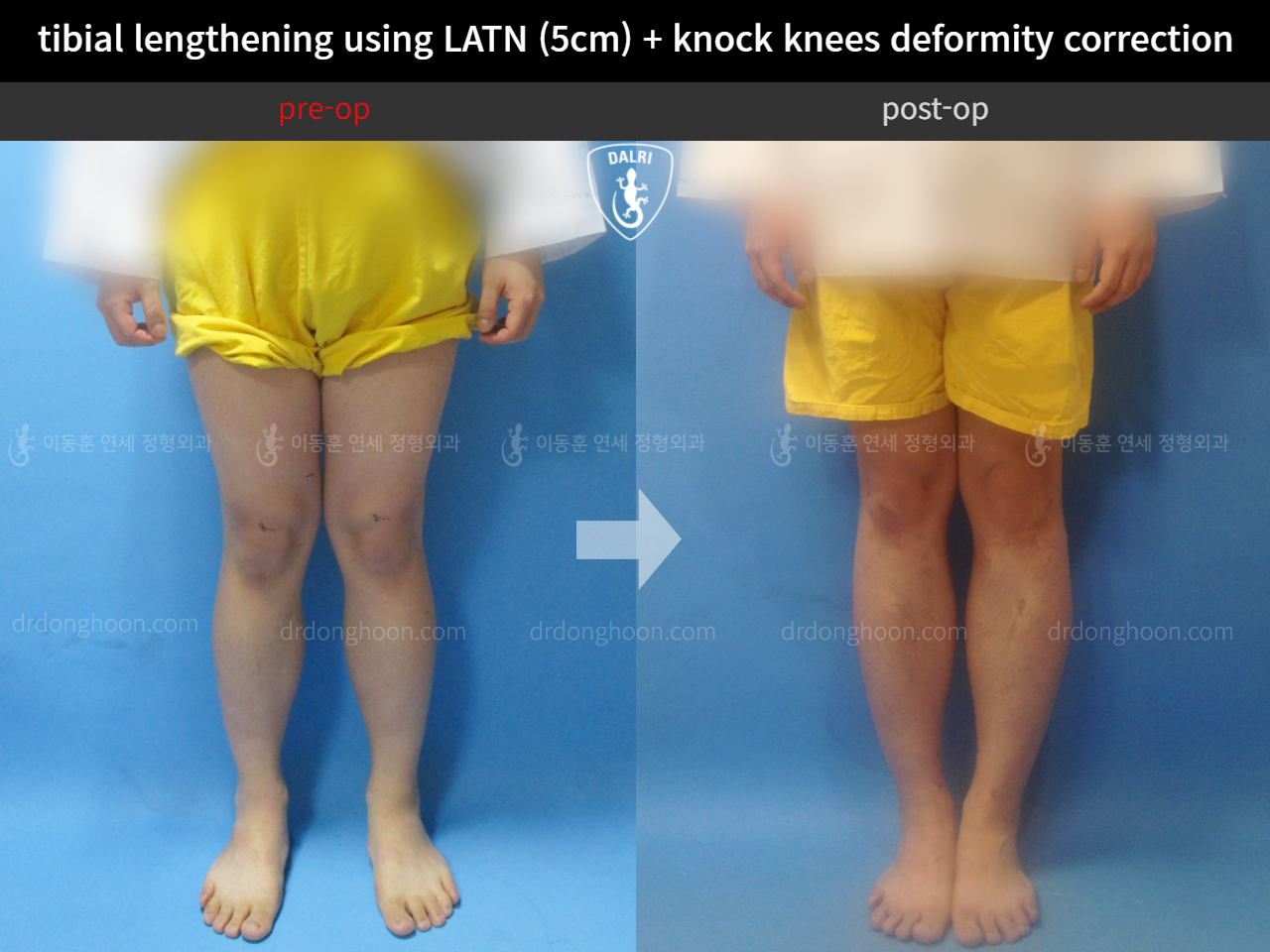 Before and after cll + deformity correction, case 4323180, image 3, Dr. Donghoon institute (DALRI)