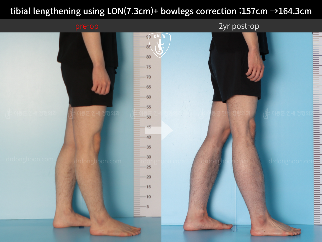 Before and after cll + deformity correction, case 13549500, image 7, Dr. Donghoon institute (DALRI)