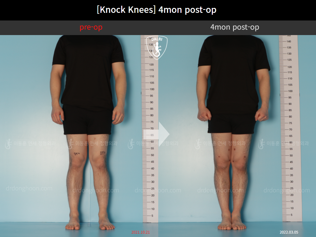 Before and after adult knock knees, case 10599771, image 1, Dr. Donghoon institute (DALRI)