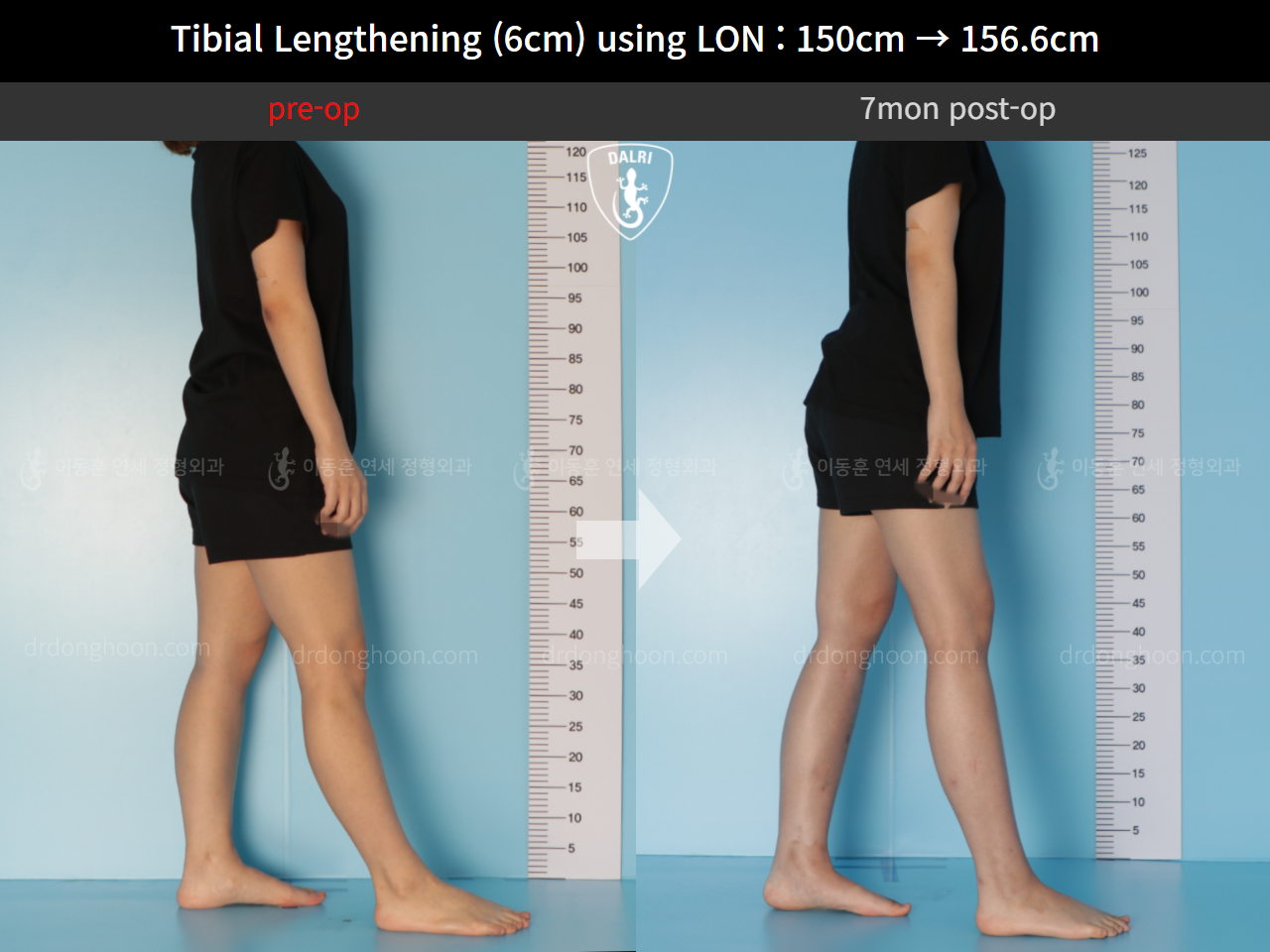 Before and after cll lon, case 9992030, image 4, Dr. Donghoon institute (DALRI)
