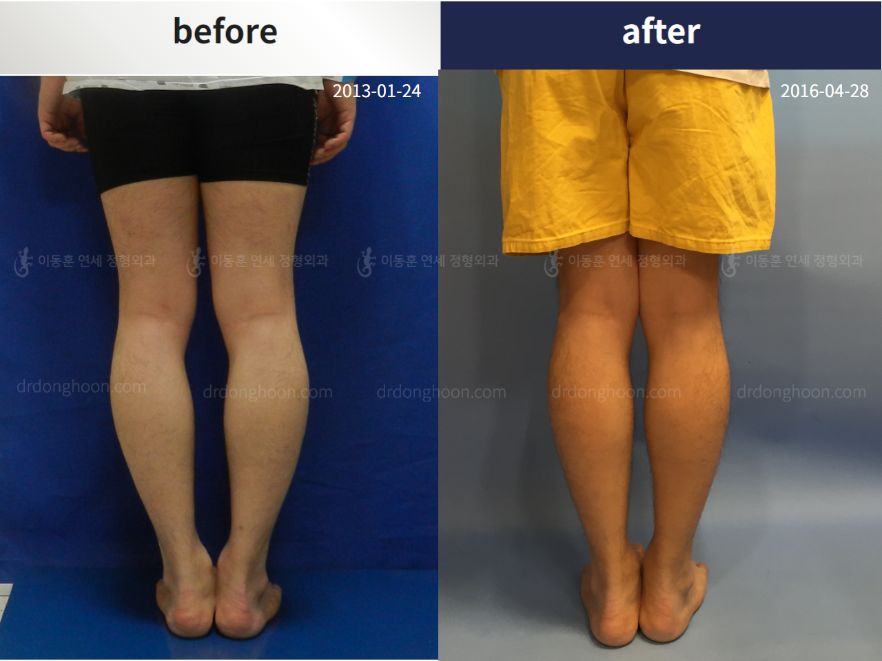 Before and after adult bowlegs, case 4311102, image 2, Dr. Donghoon institute (DALRI)