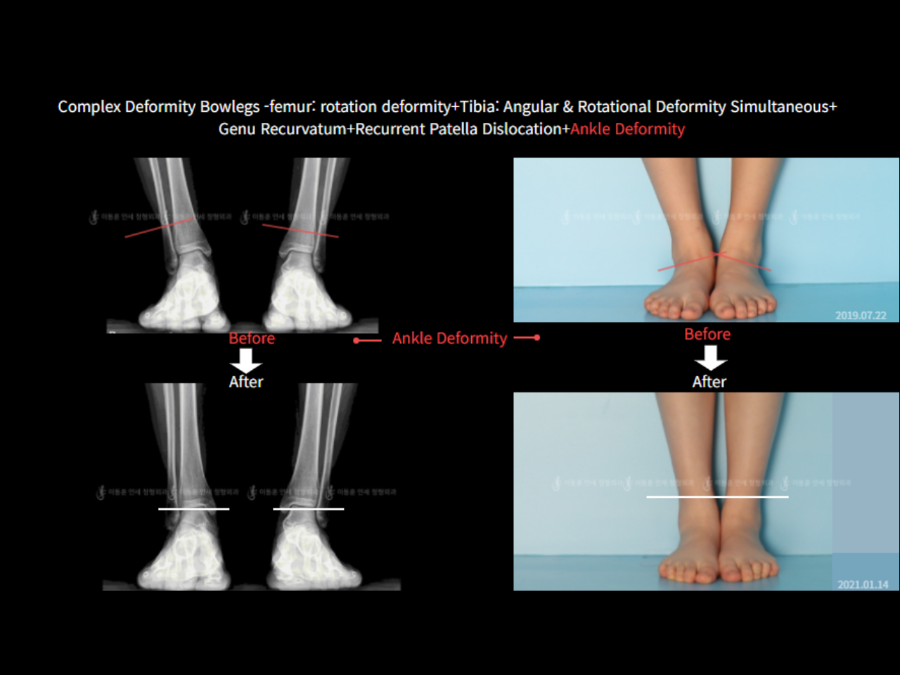 Before and after adult bowlegs, case 6883070, image 6, Dr. Donghoon institute (DALRI)
