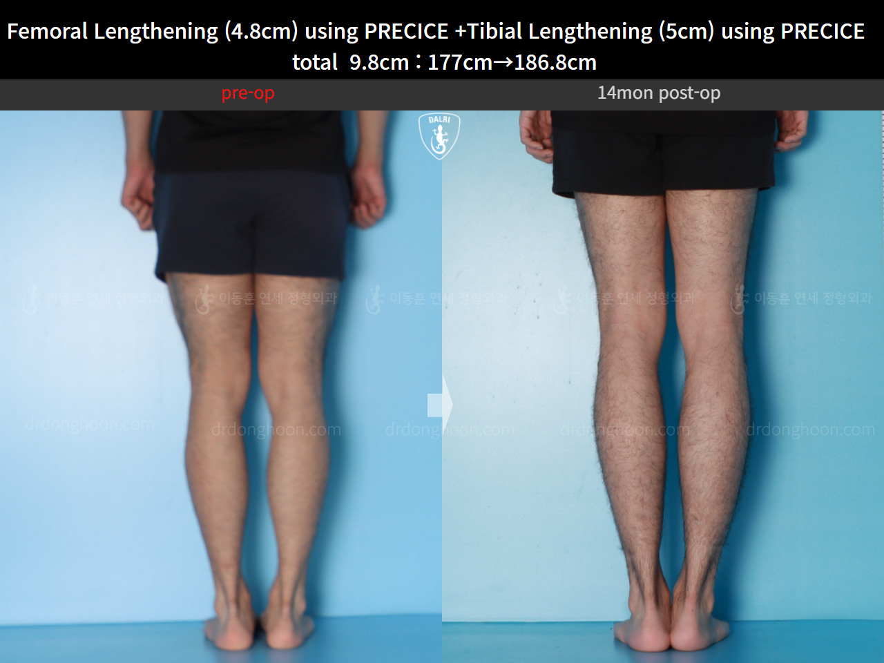 Before and after cll precice, case 16780196, image 8, Dr. Donghoon institute (DALRI)