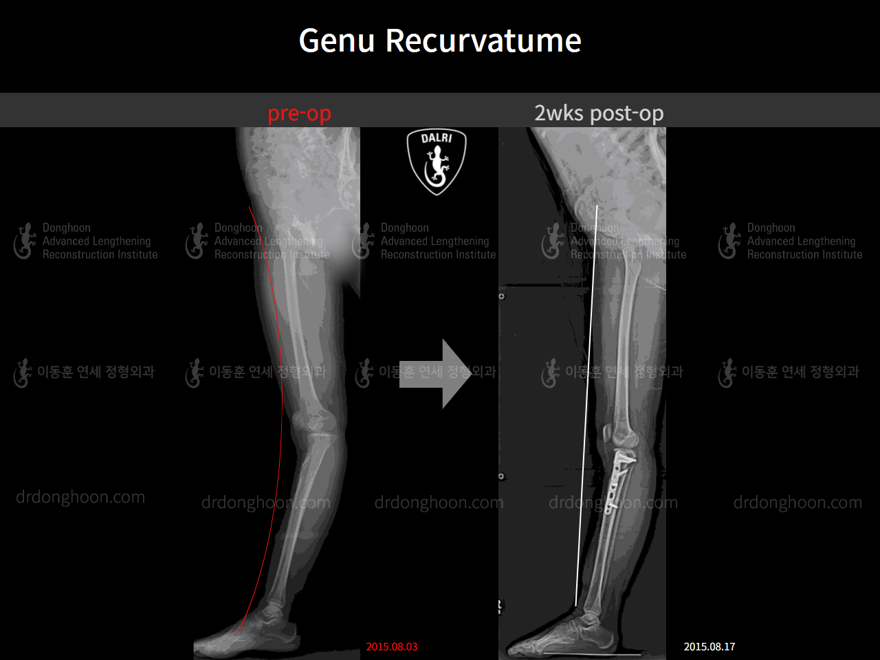 Before and after genu recurvatum, case 4541510, image 1, Dr. Donghoon institute (DALRI)