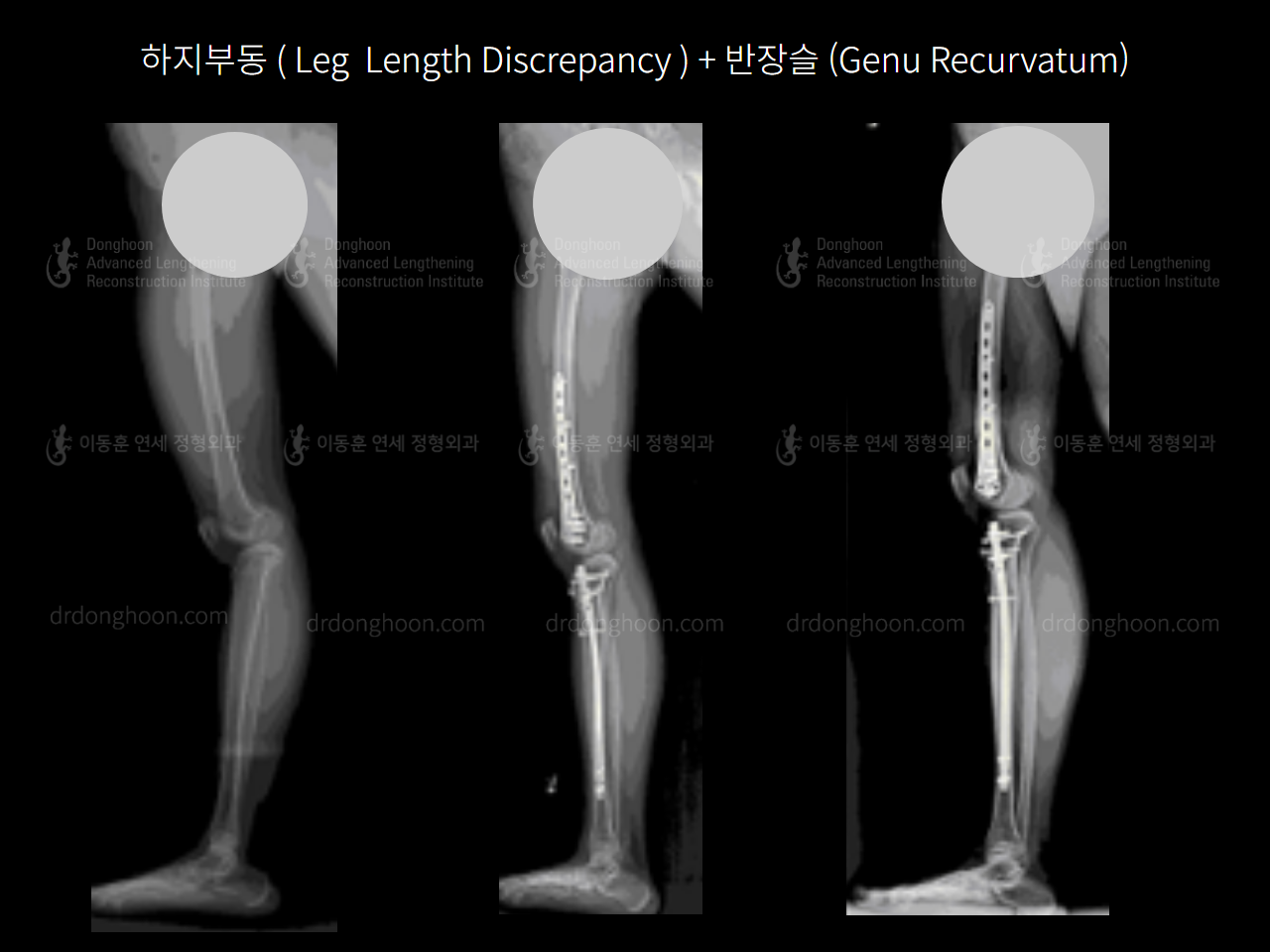 Before and after genu recurvatum, case 4250803, image 2, Dr. Donghoon institute (DALRI)