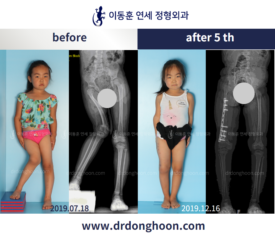 Before and after paediatric congenital condition, case 4304803, image 2, Dr. Donghoon institute (DALRI)