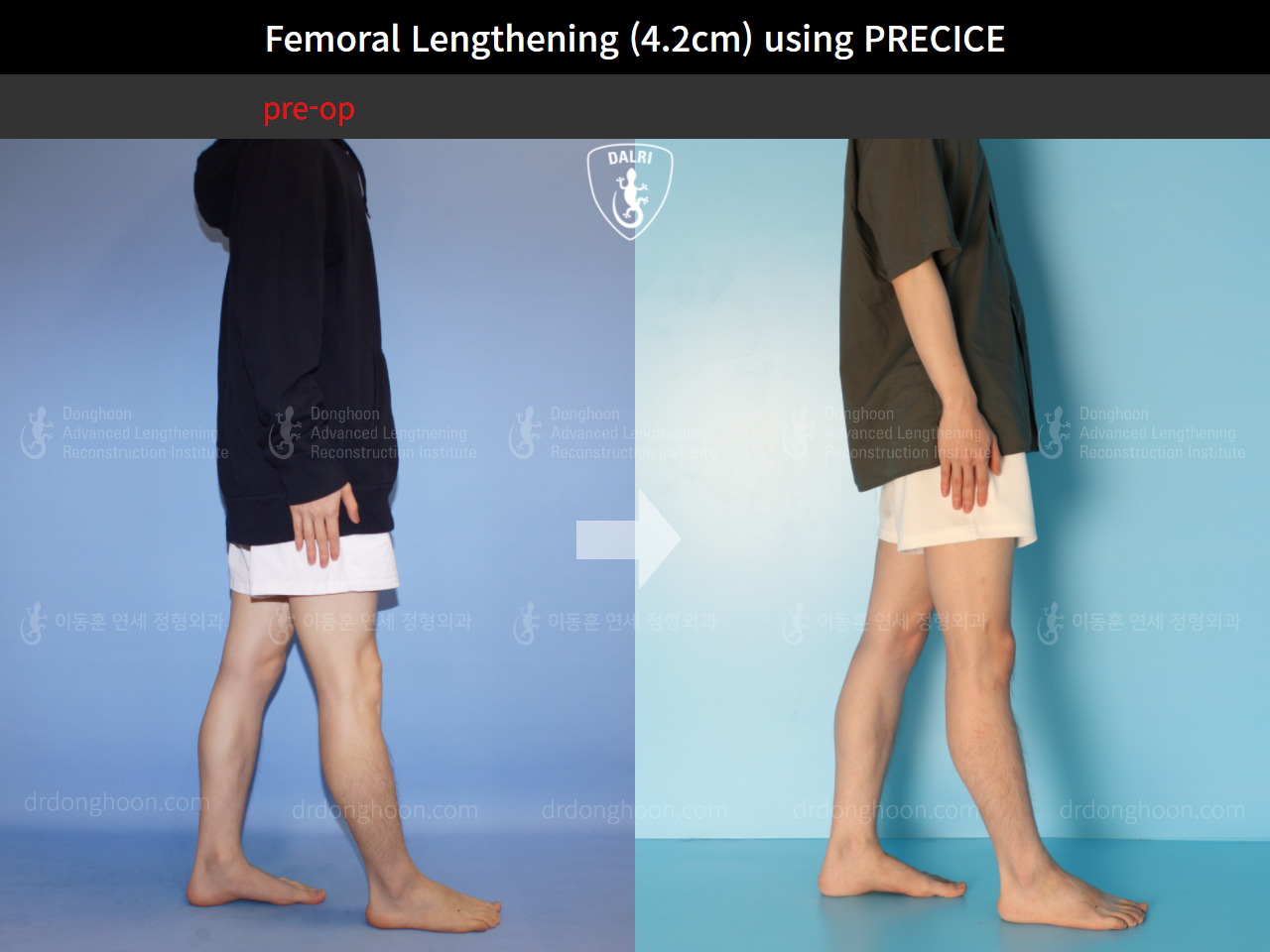 Before and after cll precice, case 4323396, image 3, Dr. Donghoon institute (DALRI)