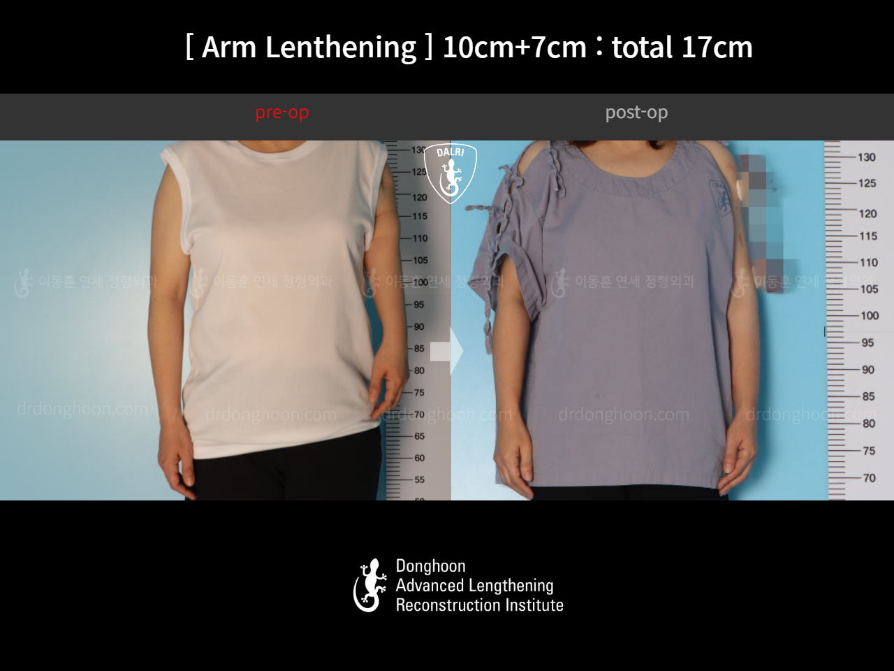 Before and after arm lengthening, case 17457909, image 3, Dr. Donghoon institute (DALRI)