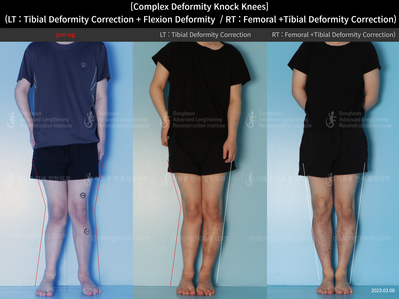 Before and after adult knock knees, case 14439339, image 1, Dr. Donghoon institute (DALRI)