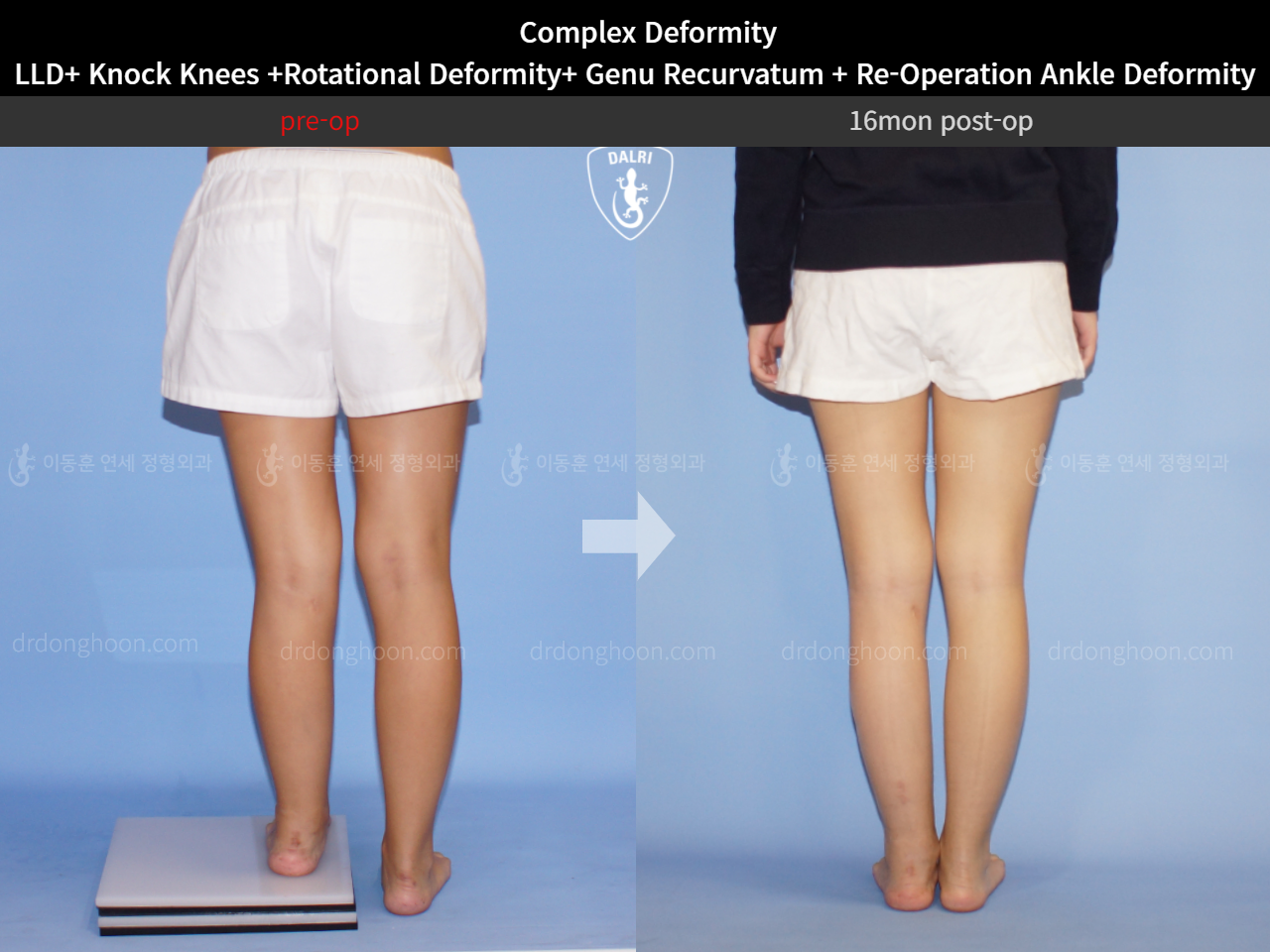 Before and after adult lld, case 5301879, image 5, Dr. Donghoon institute (DALRI)