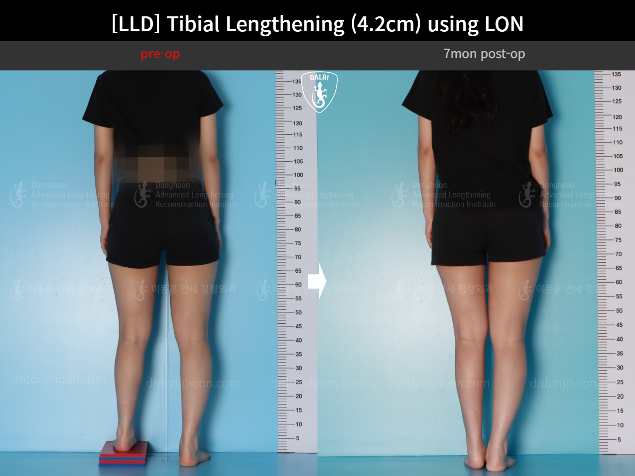Before and after adult lld, case 16933852, image 4, Dr. Donghoon institute (DALRI)