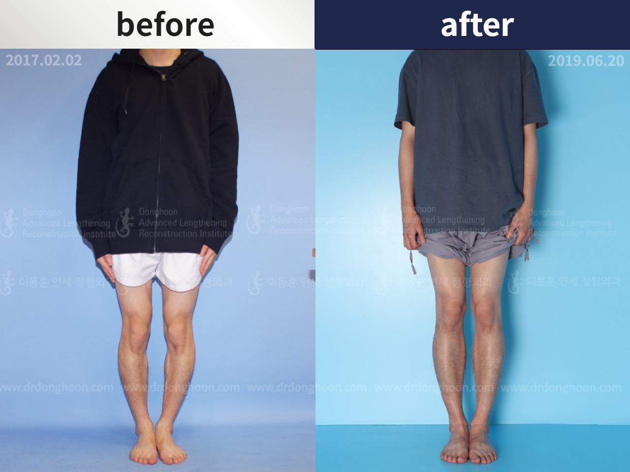 Before and after cll + deformity correction, case 4585657, image 1, Dr. Donghoon institute (DALRI)
