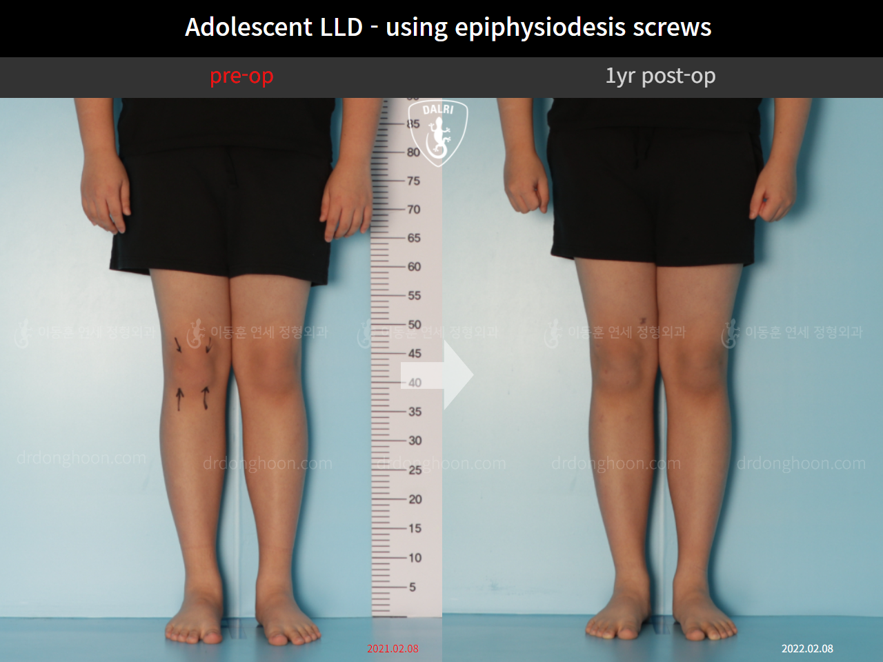 Before and after paediatric & adolescent lld, case 10291768, image 3, Dr. Donghoon institute (DALRI)