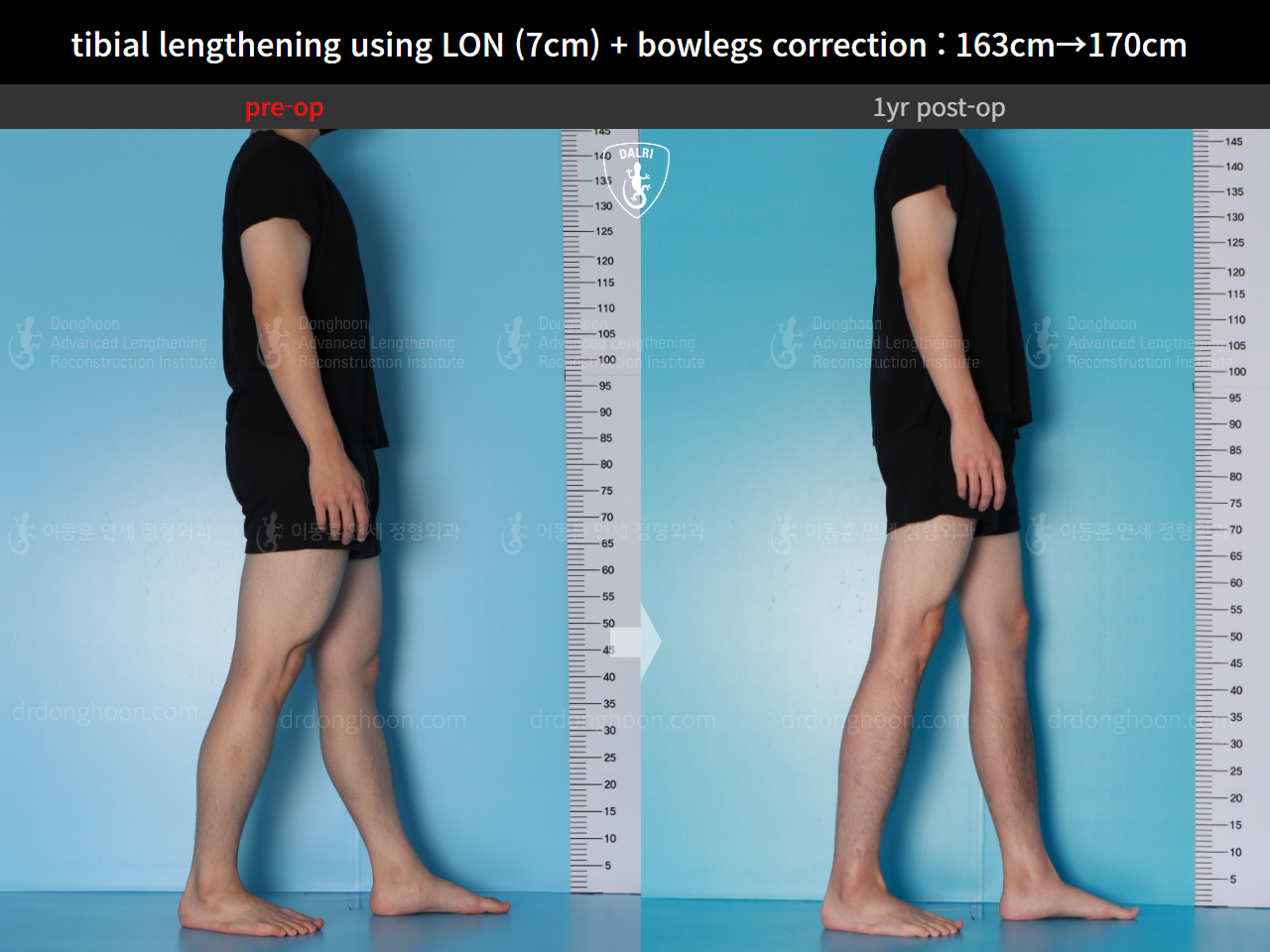 Before and after cll lon, case 16131902, image 8, Dr. Donghoon institute (DALRI)